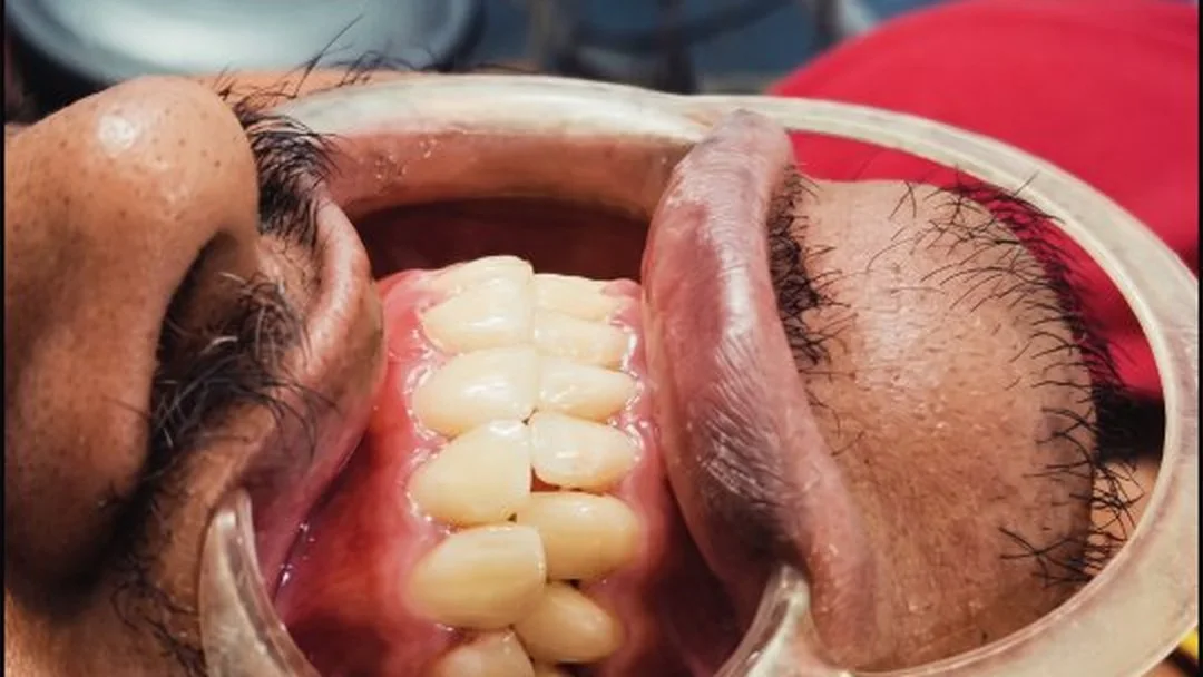 Direct composite veneers on the upper front teeth, from the clinic's Instagram.